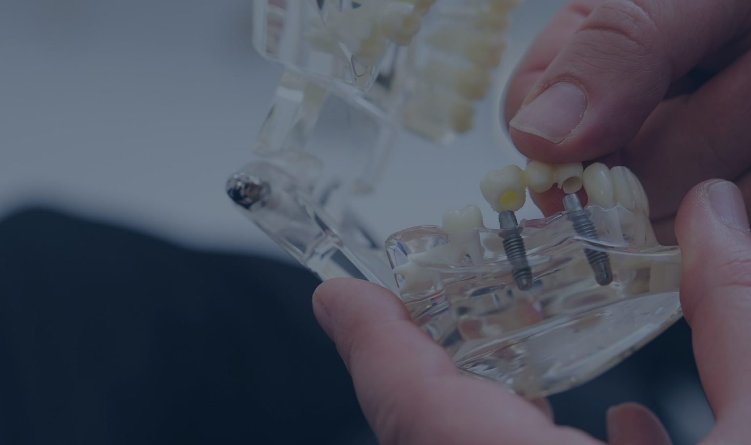 Root Canal Treatment Specialist Endodontics Birmingham Walsall